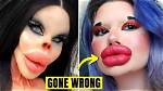 Botched Cosmetic Surgeries and the Viral 'Monsters, Inc. Lips' Phenomenon Explained