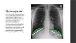 How Tall Is Clavicular? Fact-Checking Rumors, Claims, and Surgeries