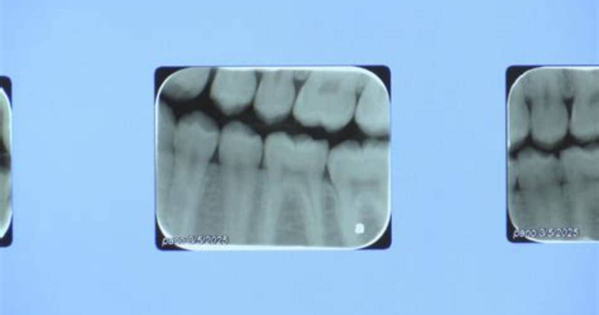 Madison Marks 12 Months Without Water Fluoride as Dental Warnings Escalate