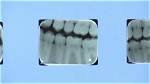 Madison Marks 12 Months Without Water Fluoride as Dental Warnings Escalate