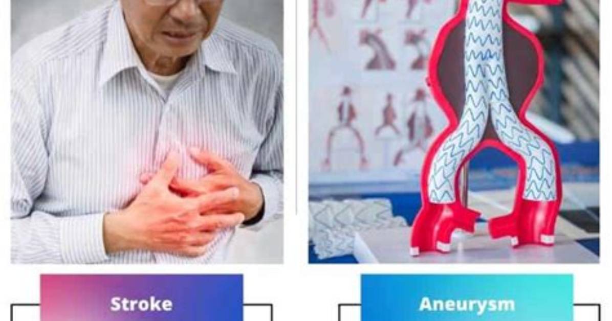 Stroke vs Aneurysm on Scans: How Doctors Spot the Difference Under Pressure