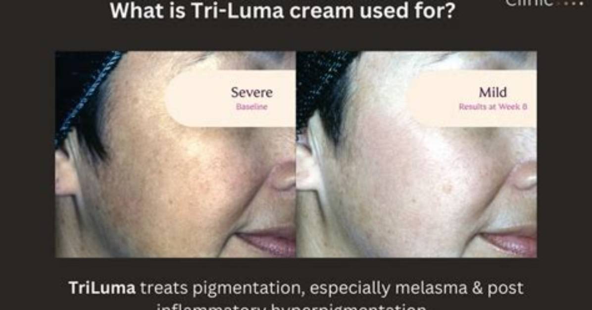 Tri-Luma Cream Before and After: Clinical Results on Stubborn Melasma