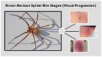 Visual Progression Guide: Identifying Brown Recluse Spider Bite Stages Through Real Lesions