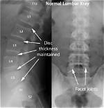What Lumbago Looks Like on Scans: Anatomy of Acute Lower Back Pain