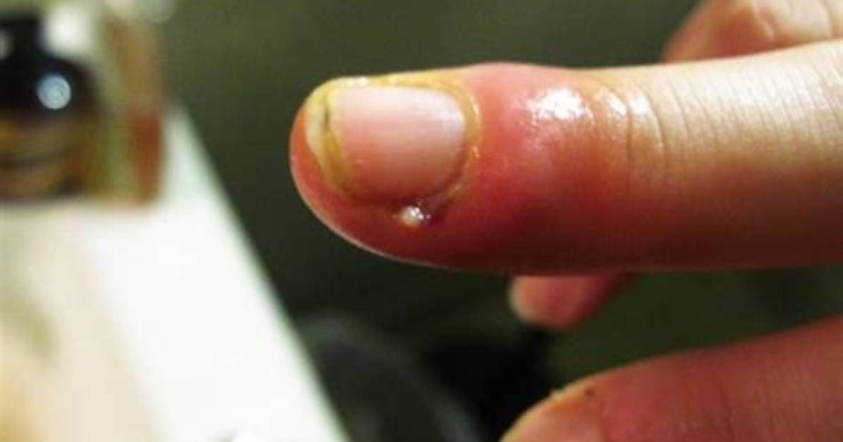 Why You Should Never Rip a Hangnail: the Hidden Danger of Sepsis and Paronychia