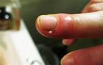 Why You Should Never Rip a Hangnail: the Hidden Danger of Sepsis and Paronychia